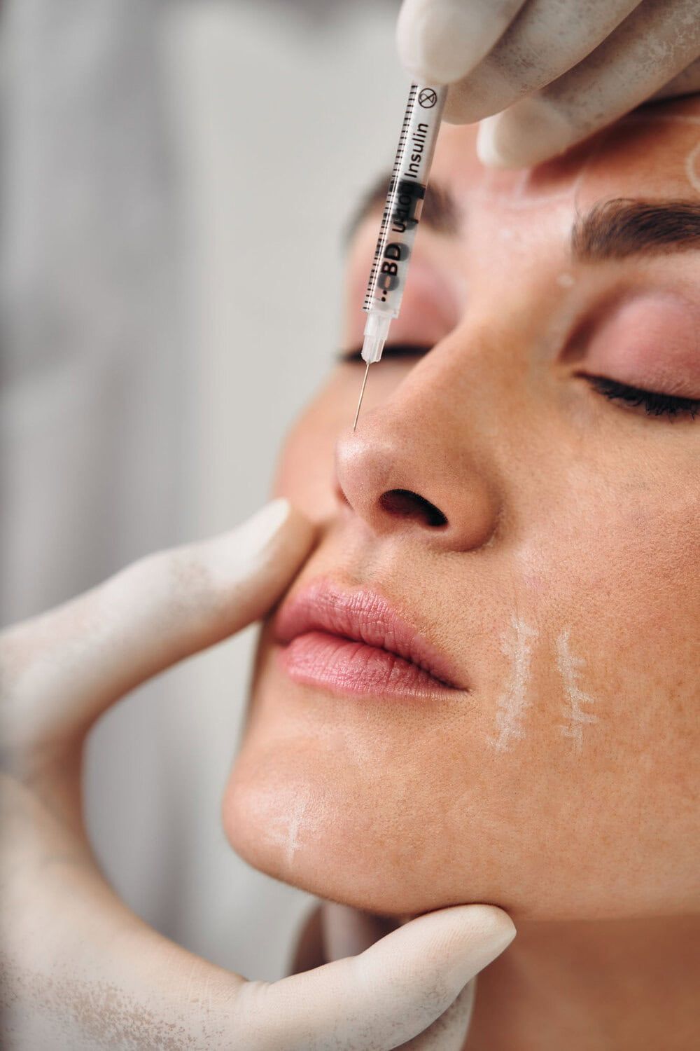 Zwangere vrouw krijgt filler injectie op gezicht bij skincare kliniek in Nederland.