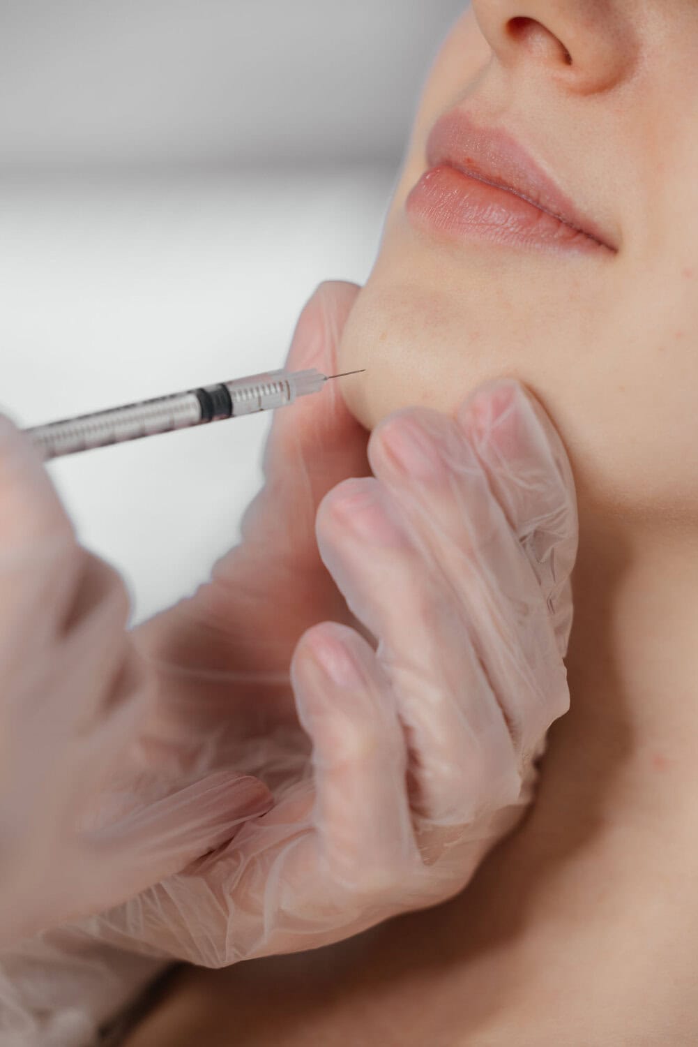 Painless lip filler injection procedure at Glow Clinic in Amsterdam. Experienced specialists ensure natural results.